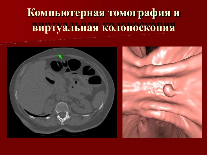 Компьютерная томография и виртуальная колоноскопия