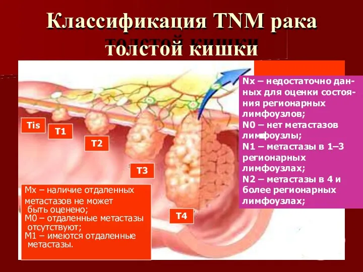 Классификация TNM рака толстой кишки Tis T1 T2 T3 T4