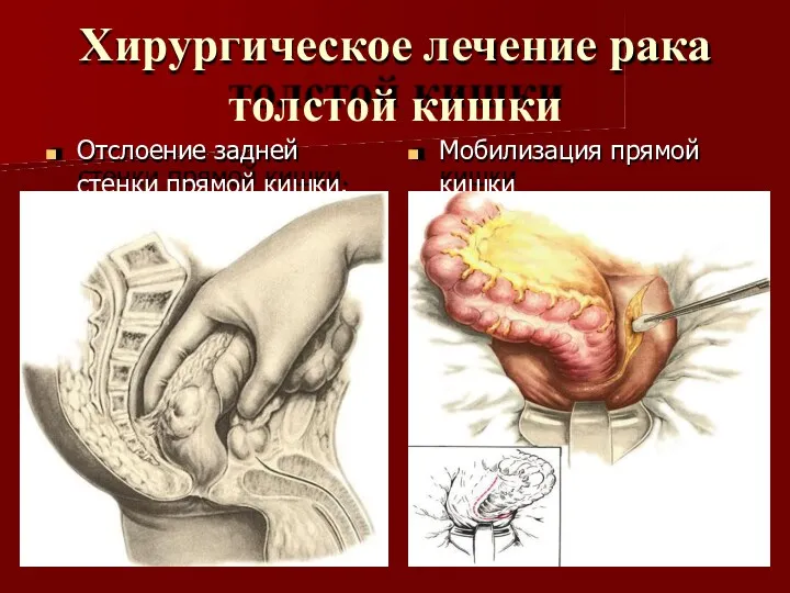 Хирургическое лечение рака толстой кишки Отслоение задней стенки прямой кишки. Мобилизация прямой кишки