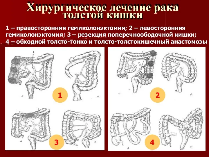 Хирургическое лечение рака толстой кишки 1 – правосторонняя гемиколонэктомия; 2