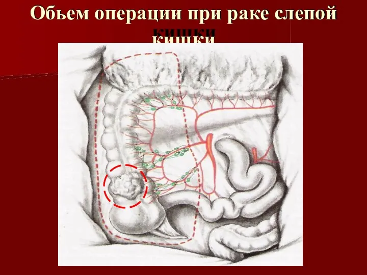 Обьем операции при раке слепой кишки