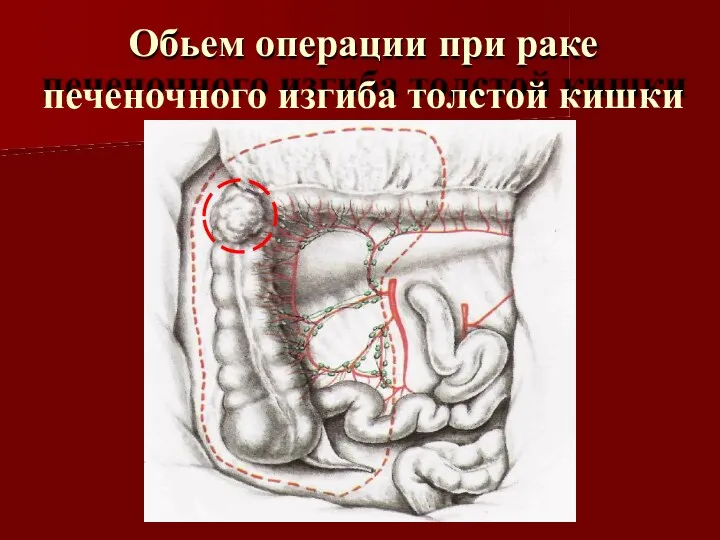 Обьем операции при раке печеночного изгиба толстой кишки