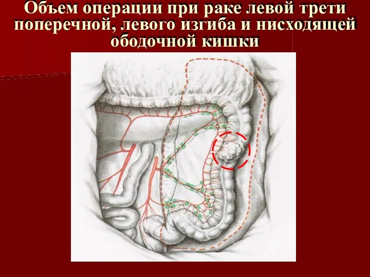 Объем операции при раке левой трети поперечной, левого изгиба и нисходящей ободочной кишки