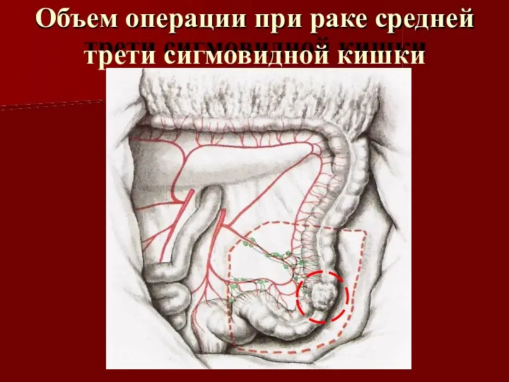 Объем операции при раке средней трети сигмовидной кишки