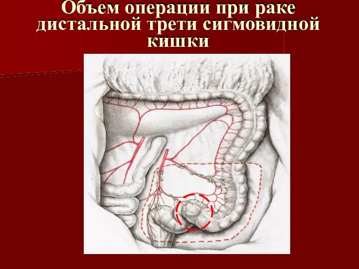 Объем операции при раке дистальной трети сигмовидной кишки