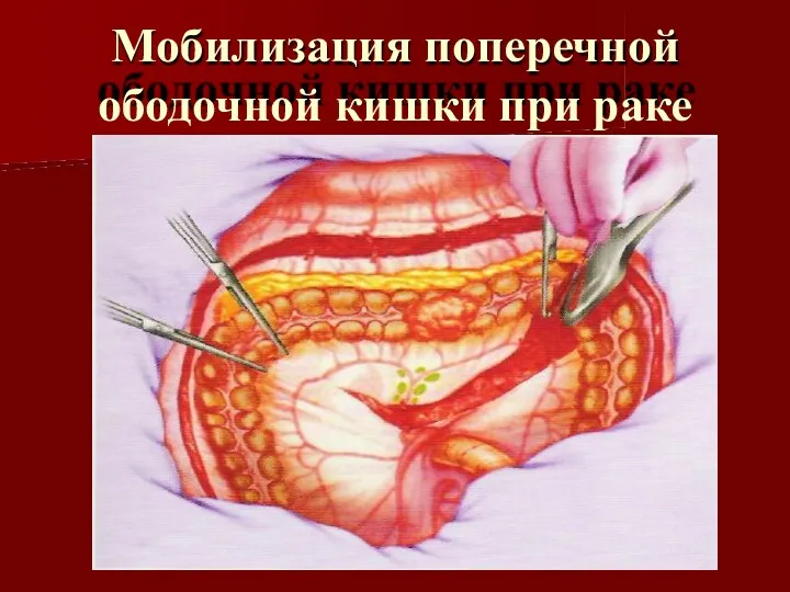 Мобилизация поперечной ободочной кишки при раке