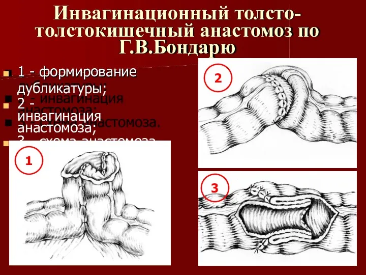 Инвагинационный толсто- толстокишечный анастомоз по Г.В.Бондарю 1 - формирование дубликатуры;