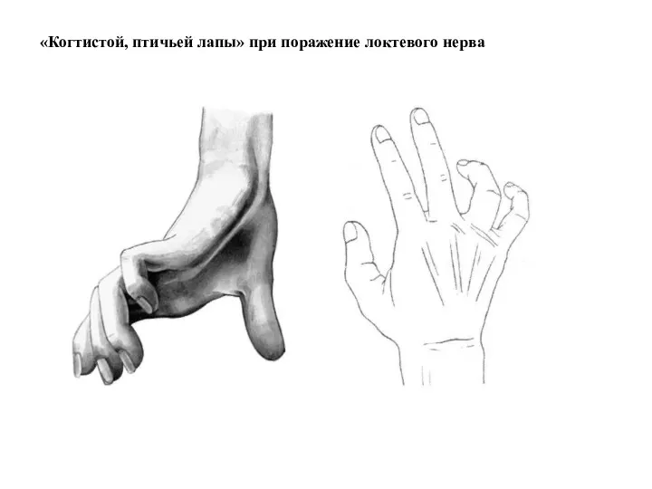 «Когтистой, птичьей лапы» при поражение локтевого нерва