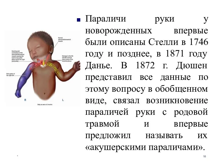 Параличи руки у новорожденных впервые были описаны Стелли в 1746