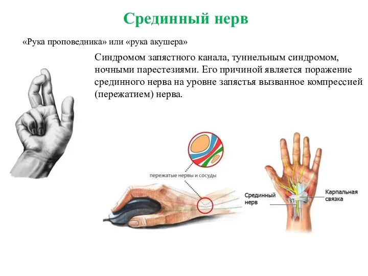 «Рука проповедника» или «рука акушера» Срединный нерв Синдромом запястного канала,