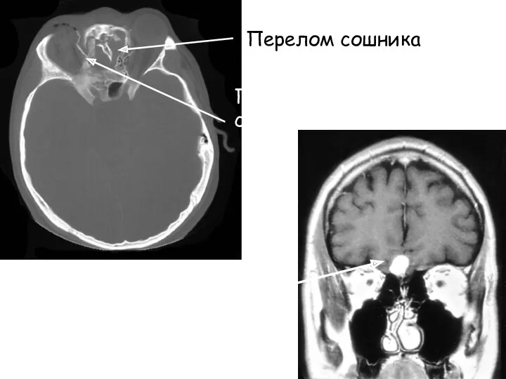 Перелом сошника Перелом медиальной стенки орбиты Опухоль ольфакторной ямки