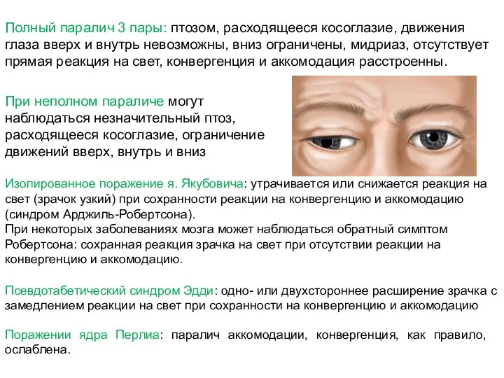 Полный паралич 3 пары: птозом, расходящееся косоглазие, движения глаза вверх