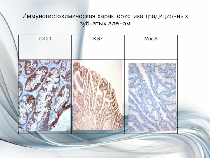 Иммуногистохимическая характеристика традиционных зубчатых аденом