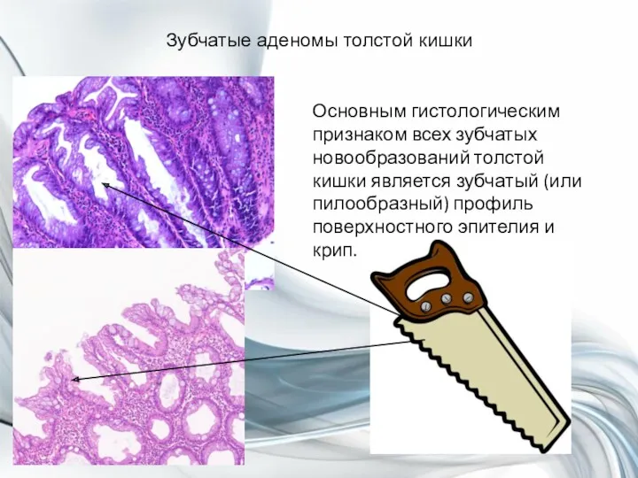 Зубчатые аденомы толстой кишки Основным гистологическим признаком всех зубчатых новообразований