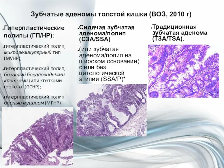 Зубчатые аденомы толстой кишки (ВОЗ, 2010 г) Гиперпластические полипы (ГП/HP):