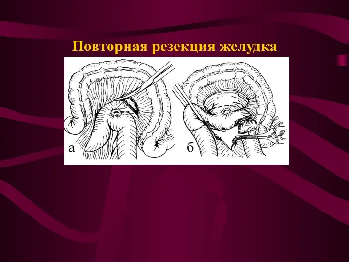 Повторная резекция желудка