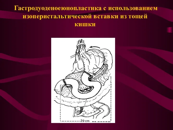 Гастродуоденоеюнопластика с использованием изоперистальтической вставки из тощей кишки