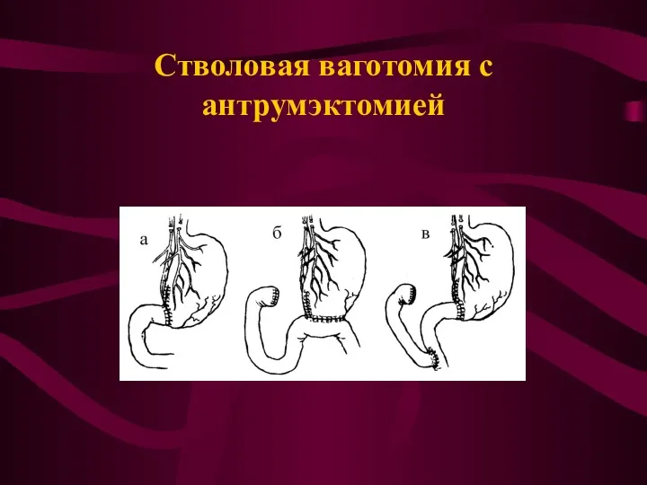 Стволовая ваготомия с антрумэктомией