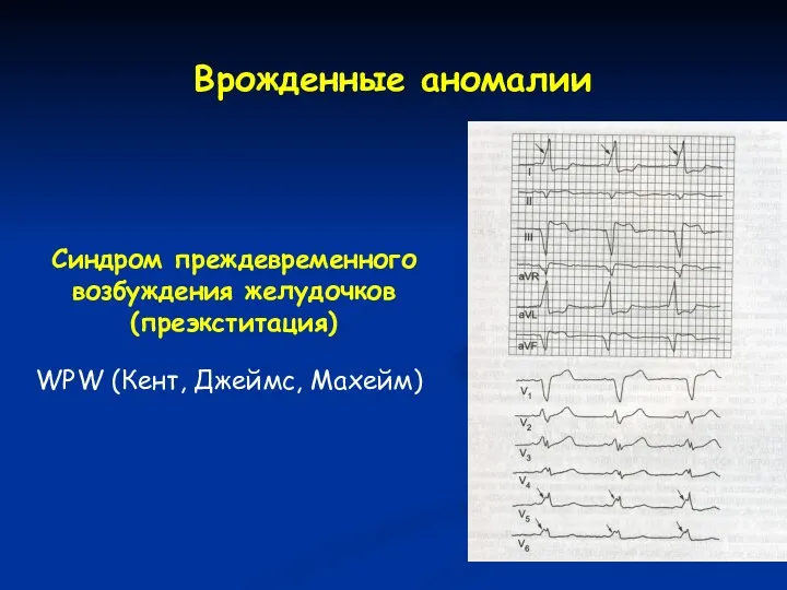 Врожденные аномалии Синдром преждевременного возбуждения желудочков (преэкститация) WPW (Кент, Джеймс, Махейм)