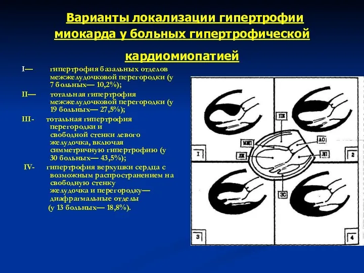 Варианты локализации гипертрофии миокарда у больных гипертрофической кардиомиопатией I— гипертрофия