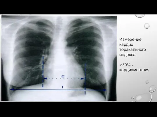 Измерение кардио-торакального индекса. >50% - кардиомегалия