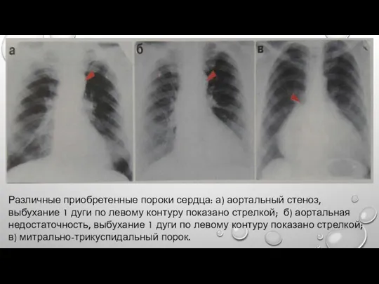 Различные приобретенные пороки сердца: а) аортальный стеноз, выбухание 1 дуги