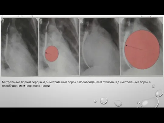 Митральные пороки сердца: а,б) митральный порок с преобладанием стеноза; в,г ) митральный порок с преобладанием недостаточности.