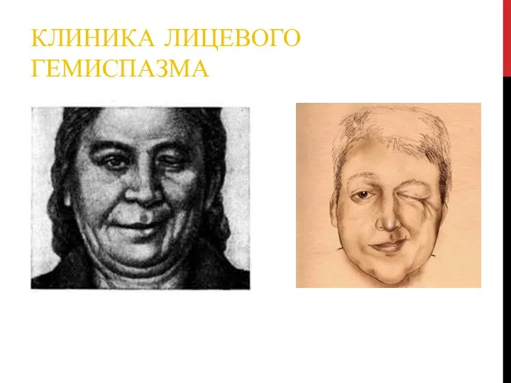 КЛИНИКА ЛИЦЕВОГО ГЕМИСПАЗМА