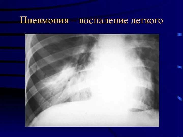 Пневмония – воспаление легкого