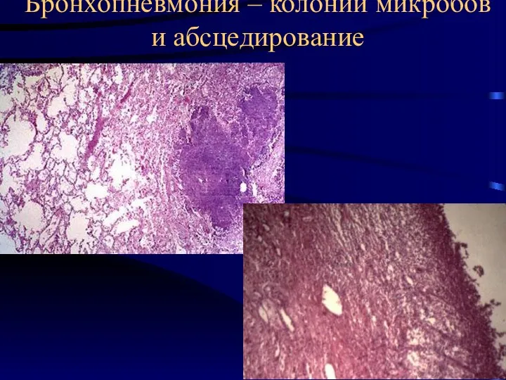 Бронхопневмония – колонии микробов и абсцедирование