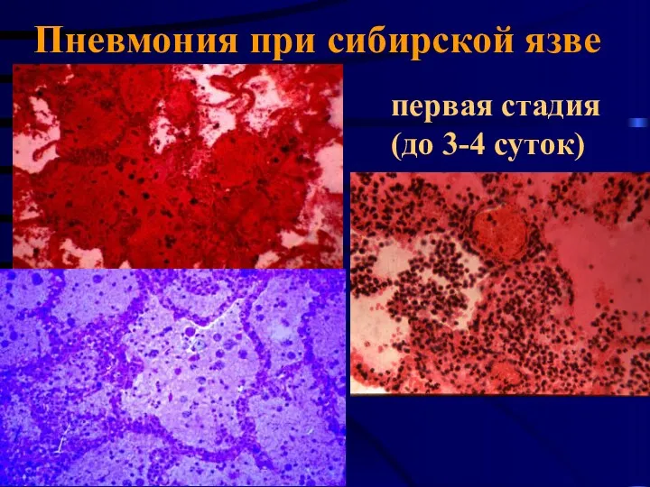 Пневмония при сибирской язве первая стадия (до 3-4 суток)