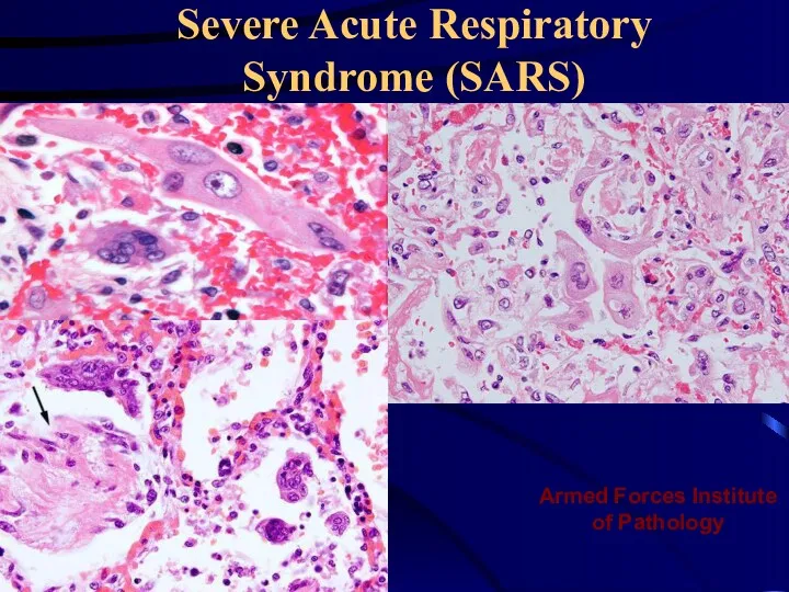 Severe Acute Respiratory Syndrome (SARS) Armed Forces Institute of Pathology