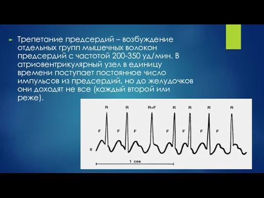 Трепетание предсердий – возбуждение отдельных групп мышечных волокон предсердий с