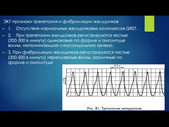 ЭКГ признаки трепетания и фибрилляции желудочков 1. Отсутствие нормальных желудочковых