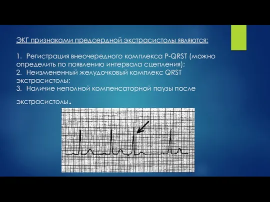 ЭКГ признаками предсердной экстрасистолы являются: 1. Регистрация внеочередного комплекса P-QRST