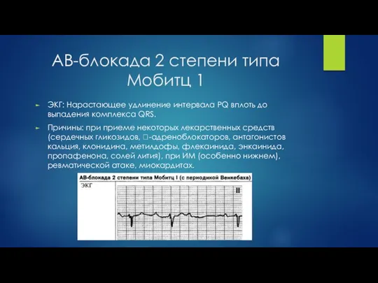 АВ-блокада 2 степени типа Мобитц 1 ЭКГ: Нарастающее удлинение интервала