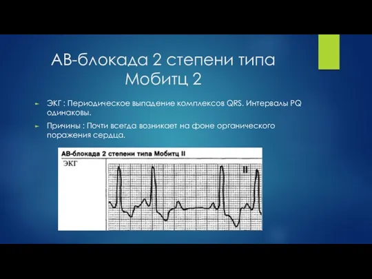 АВ-блокада 2 степени типа Мобитц 2 ЭКГ : Периодическое выпадение