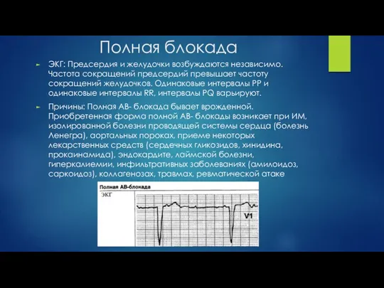 Полная блокада ЭКГ: Предсердия и желудочки возбуждаются независимо. Частота сокращений