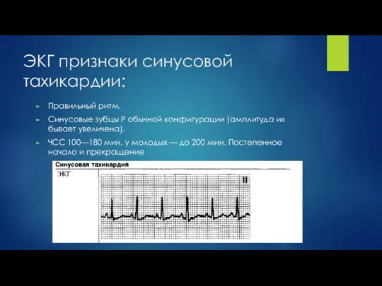 ЭКГ признаки синусовой тахикардии: Правильный ритм. Синусовые зубцы Р обычной