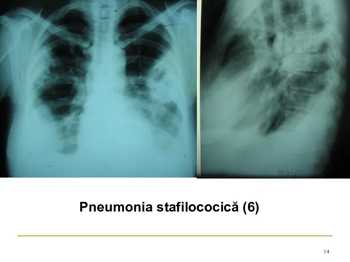 Pneumonia stafilococică (6)