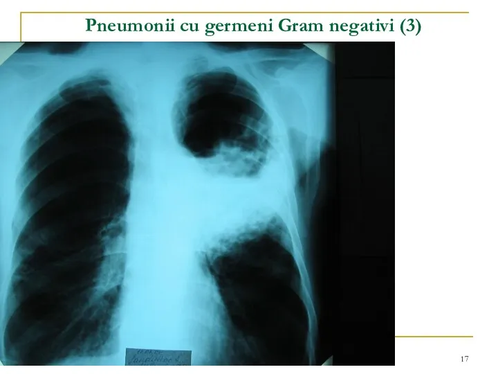 Pneumonii cu germeni Gram negativi (3)