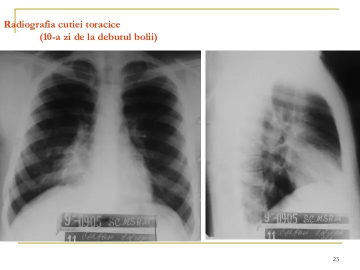 Radiografia cutiei toracice (10-a zi de la debutul bolii)