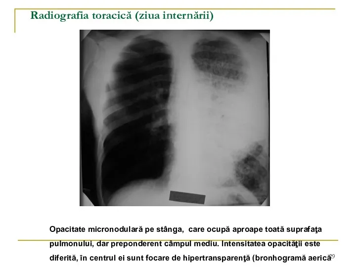 Radiografia toracică (ziua internării) Opacitate micronodulară pe stânga, care ocupă