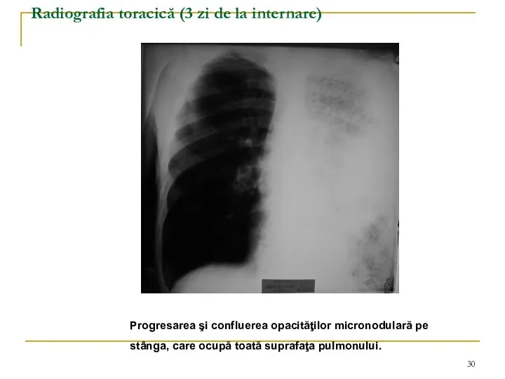Radiografia toracică (3 zi de la internare) Progresarea şi confluerea opacităţilor micronodulară pe