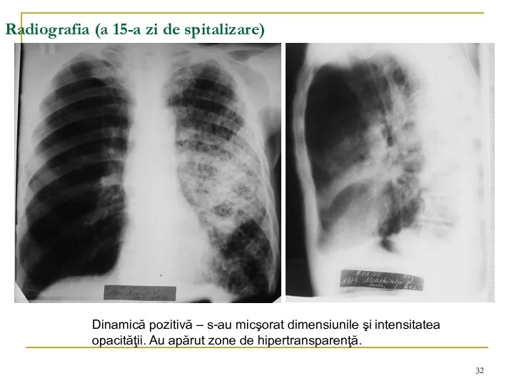 Radiografia (a 15-a zi de spitalizare) Dinamică pozitivă – s-au micşorat dimensiunile şi