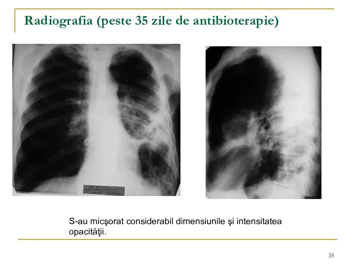 Radiografia (peste 35 zile de antibioterapie) S-au micşorat considerabil dimensiunile şi intensitatea opacităţii.