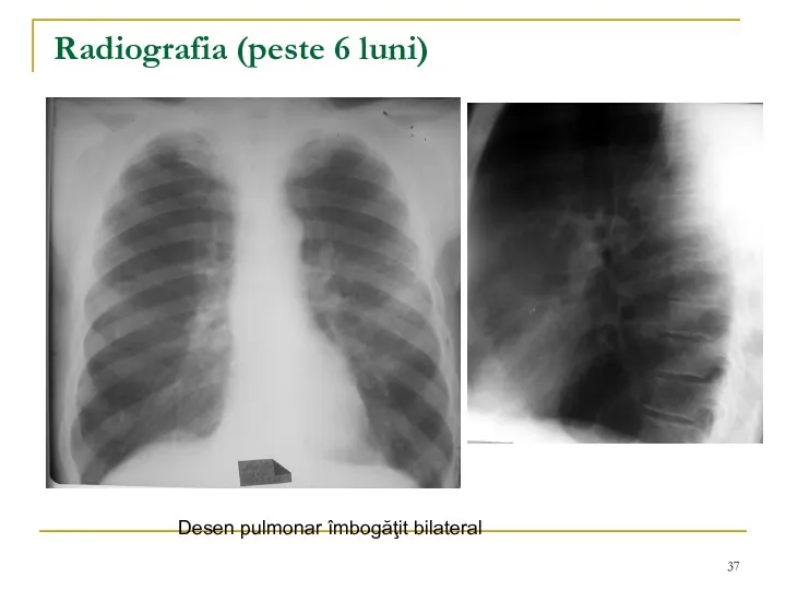 Radiografia (peste 6 luni) Desen pulmonar îmbogăţit bilateral