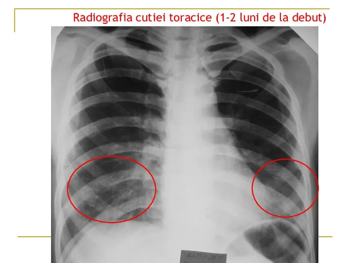 Radiografia cutiei toracice (1-2 luni de la debut)