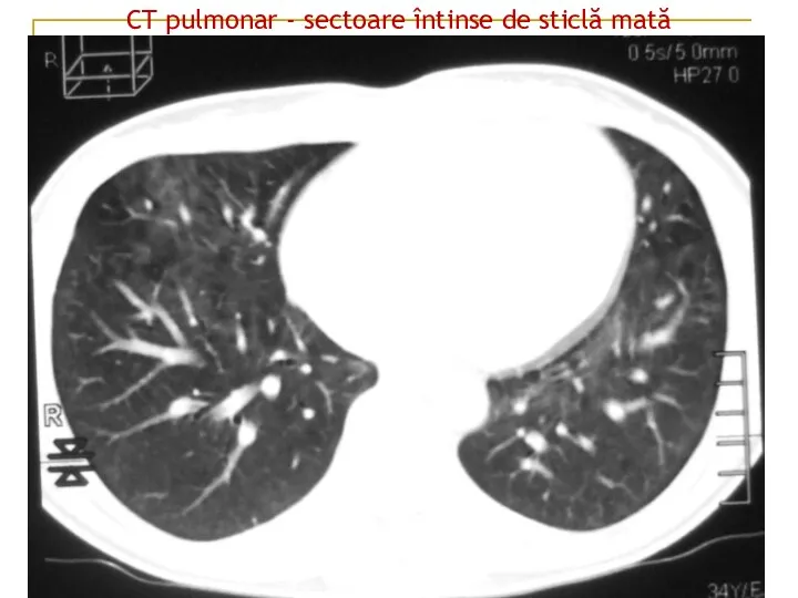 CT pulmonar - sectoare întinse de sticlă mată