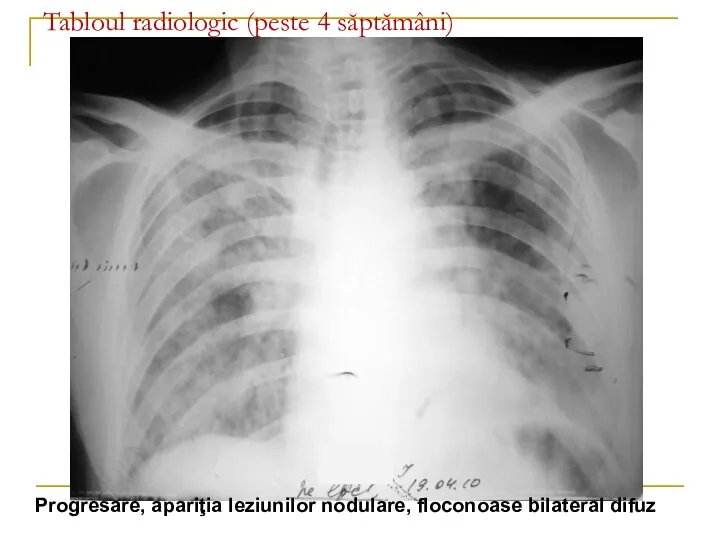 Tabloul radiologic (peste 4 săptămâni) Progresare, apariţia leziunilor nodulare, floconoase bilateral difuz